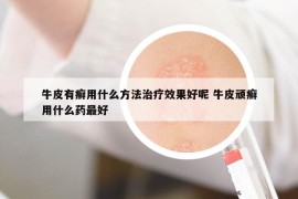 牛皮有癣用什么方法治疗效果好呢 牛皮顽癣用什么药最好