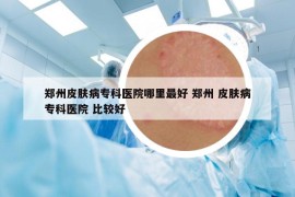 郑州皮肤病专科医院哪里最好 郑州 皮肤病专科医院 比较好