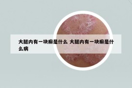 大腿内有一块癣是什么 大腿内有一块癣是什么病