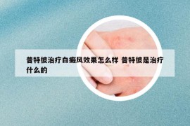 普特彼治疗白癜风效果怎么样 普特彼是治疗什么的