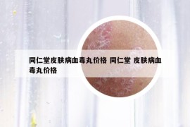 同仁堂皮肤病血毒丸价格 同仁堂 皮肤病血毒丸价格