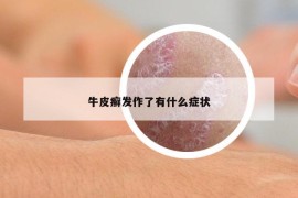 牛皮癣发作了有什么症状