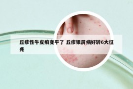 丘疹性牛皮癣变平了 丘疹银屑病好转6大征兆