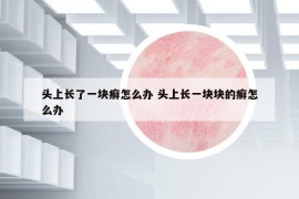 头上长了一块癣怎么办 头上长一块块的癣怎么办