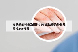 皮肤癣的种类及图片360 皮肤癣的种类及图片360度图