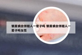 银屑病会伴随人一辈子吗 银屑病会伴随人一辈子吗女性