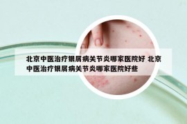 北京中医治疗银屑病关节炎哪家医院好 北京中医治疗银屑病关节炎哪家医院好些