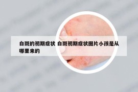 白斑的初期症状 白斑初期症状图片小孩是从哪里来的