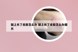 腿上长了皮藓怎么办 腿上长了皮藓怎么办图片