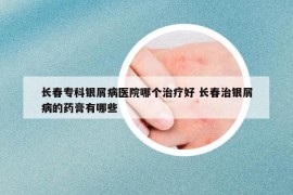 长春专科银屑病医院哪个治疗好 长春治银屑病的药膏有哪些