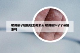 银屑病孕检能检查出来么 银屑病怀孕了会加重吗