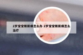 2岁宝宝银屑病怎么办 2岁宝宝银屑病怎么治疗