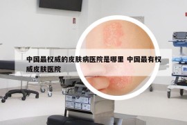 中国最权威的皮肤病医院是哪里 中国最有权威皮肤医院