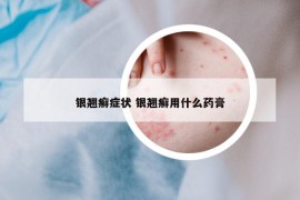 银翘癣症状 银翘癣用什么药膏