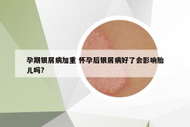 孕期银屑病加重 怀孕后银屑病好了会影响胎儿吗?