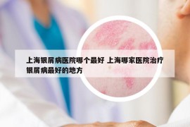 上海银屑病医院哪个最好 上海哪家医院治疗银屑病最好的地方