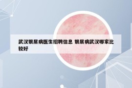 武汉银屑病医生招聘信息 银屑病武汉哪家比较好