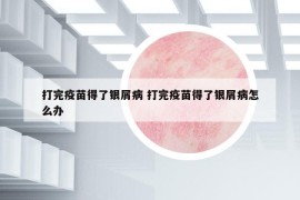 打完疫苗得了银屑病 打完疫苗得了银屑病怎么办