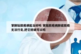 掌脚趾脓疱病能治好吗 掌跖脓疱病脚底脓疱无法行走,把它挑破可以吗