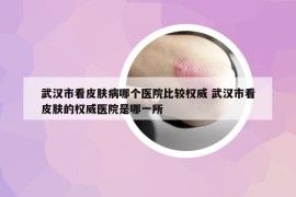 武汉市看皮肤病哪个医院比较权威 武汉市看皮肤的权威医院是哪一所