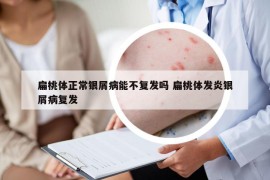 扁桃体正常银屑病能不复发吗 扁桃体发炎银屑病复发