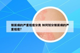 银屑病的严重程度分类 如何划分银屑病的严重程度?