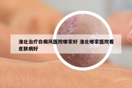 淮北治疗白癜风医院哪家好 淮北哪家医院看皮肤病好