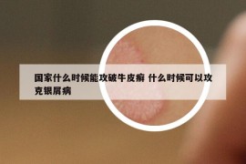 国家什么时候能攻破牛皮癣 什么时候可以攻克银屑病