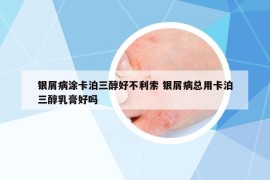 银屑病涂卡泊三醇好不利索 银屑病总用卡泊三醇乳膏好吗