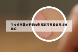 牛皮癣用莫比罗星软膏 莫匹罗星软膏可以擦藓吗