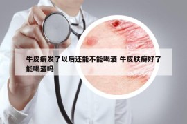 牛皮癣发了以后还能不能喝酒 牛皮肤癣好了能喝酒吗