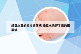 绿豆水真的能治银屑病 绿豆水洗好了我的银屑病