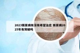 2023银屑病有没有希望治愈 银屑病2025年有突破吗