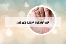 脓疱病怎么治好 脓疱病的症状