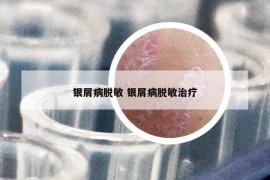 银屑病脱敏 银屑病脱敏治疗