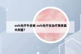 uvb光疗牛皮癣 uvb光疗仪治疗银屑最大剂量?