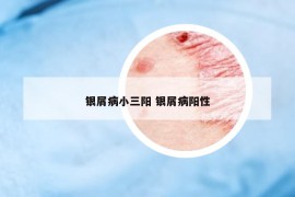 银屑病小三阳 银屑病阳性