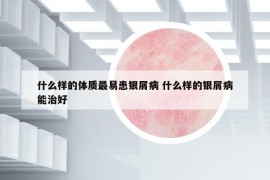 什么样的体质最易患银屑病 什么样的银屑病能治好