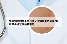 银屑病亲吻会不会传染艾滋病病毒感染者 银屑病会通过接触传染吗