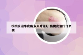 核桃皮治牛皮癣多久才能好 核桃皮治疗什么病