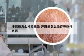 汗斑癣怎么才能根治 汗斑癣怎么治疗啊吃什么药