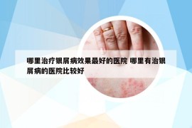 哪里治疗银屑病效果最好的医院 哪里有治银屑病的医院比较好