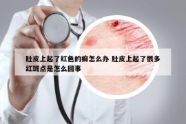 肚皮上起了红色的癣怎么办 肚皮上起了很多红斑点是怎么回事