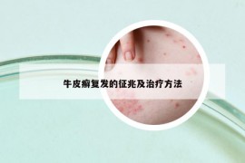 牛皮癣复发的征兆及治疗方法