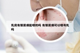 乳房有银屑病能喂奶吗 有银屑病可以喂母乳吗