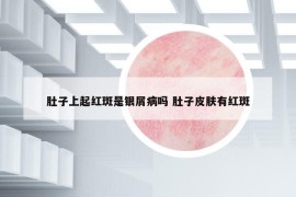 肚子上起红斑是银屑病吗 肚子皮肤有红斑