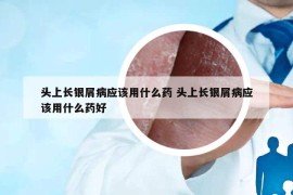 头上长银屑病应该用什么药 头上长银屑病应该用什么药好