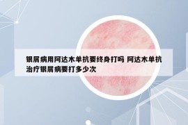 银屑病用阿达木单抗要终身打吗 阿达木单抗治疗银屑病要打多少次