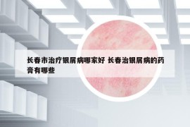 长春市治疗银屑病哪家好 长春治银屑病的药膏有哪些