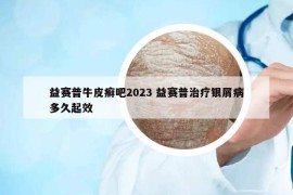 益赛普牛皮癣吧2023 益赛普治疗银屑病多久起效